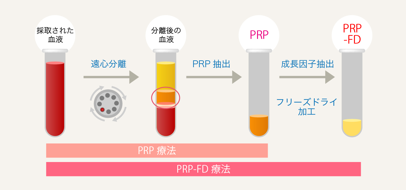 PRP-FD（PFC-FD）療法